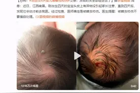 被蜱虫咬伤，该如何正确应对？图片