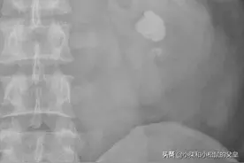 输尿管支架放了一个月，就长满石头了，这速度图片