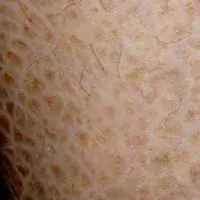 鱼鳞病发病年龄