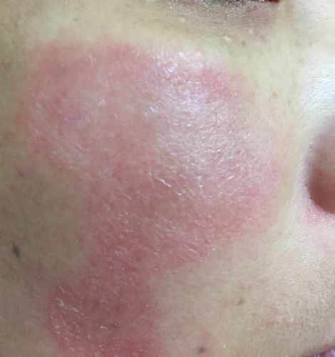 脸上有点过敏怎么办,脸过敏通常是4个原因导致的!