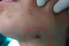 智齿反复发炎，吃药硬扛，去医院检查脸颊被戳穿图片