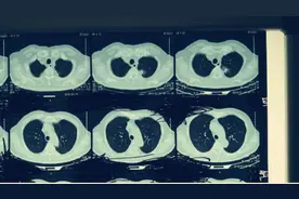 60岁的乳腺癌阿姨：术后不做任何治疗，定期复查！为啥胆战心惊？图片