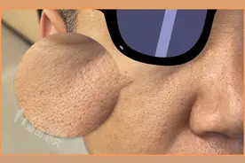 毛孔粗大怎么办？超全指南解决你的毛孔问题图片