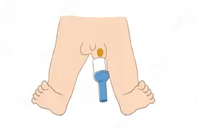 错不起！娃包皮长、丁丁小，7大私处异常，立马送医图片