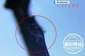 女子眼睛干痒痛，元凶竟是螨虫，长在睫毛根上图片