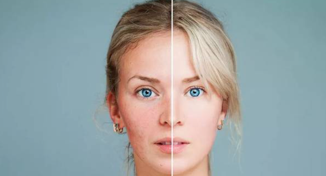 鐨偆灞忛殰鍙楁崯鎬庝箞鍔烇紵鎶よ偆鍋氬ソ杩欏嚑姝ユ槸鍏抽敭锛屽潥鎸佹墠鏈夋晥鍝? onerror=