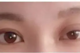 霍纳综合征图片
