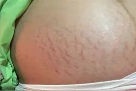 辟谣，长妊娠纹是因为胖？最主要的原因并不是胖，而是遗传图片