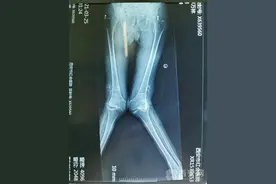 甘肃患者十年无法站立 双膝关节置换手术圆梦了图片