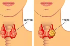 甲状腺癌还能算是癌症吗？图片