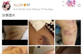 死亡宣告再次被女友实锤，不到一天时间，女友删掉“淤青照片”图片