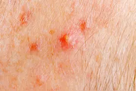 头皮上长了几粒小小的皮疹，小伙子没重视，疾病加重，不幸发生图片