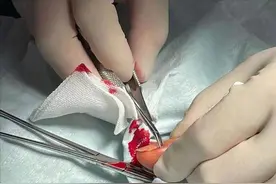 54岁邓萃雯因拔倒刺入院手术，过程像生孩子，鲜血淋漓看着都疼图片