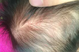 为什么有的新生儿头发浓密，有的头发稀疏？和这三个因素有关图片