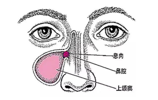 盘点鼻窦炎5大临床典型症状,耳鼻喉专家看了都说准