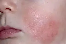 新手宝宝颈部如何清洗？湿疹痱子如何区分？图片