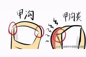 【中西合璧健康谈】注意这四点，远离甲沟炎图片