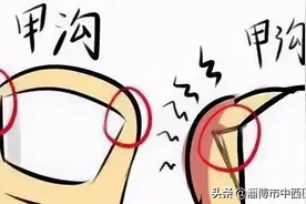 【中西合璧健康谈】注意这四点，远离甲沟炎图片