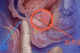 男科检查，哪些检查会造成一定不适？图片