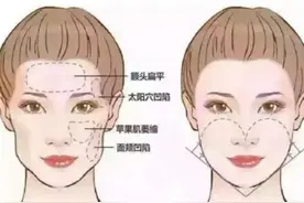 自体脂肪面部填充，让你的脂肪“动起来”图片