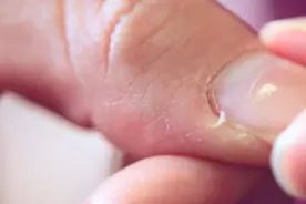 手上长不完的倒刺，真的是缺维生素吗？教你3招，轻松去除倒刺图片