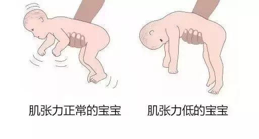 宝宝肌张力增高怎么办（儿童肌张力增高有什么表现有啥危害家长应如何正确应对）