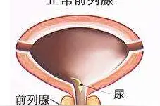 前列腺大保健：自己做一个盐包，有效对付前列腺炎，在家就能做图片