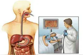 腹胀、恶心、不消化？有可能是胃息肉！要是癌变可就晚了图片