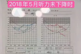 大前庭导水管综合征图片
