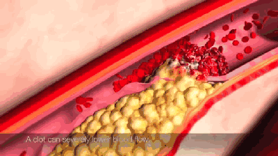 毛囊角化和气滞血瘀有关系吗