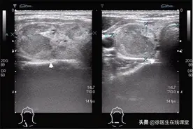 多发性甲状腺结节是不是比单发更危险？单发、多发与癌病不成正比图片