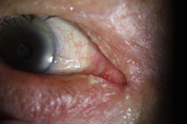 眼角化脓自己怎么处理