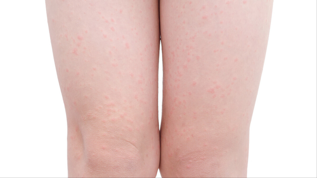 鸡皮肤还会再长么