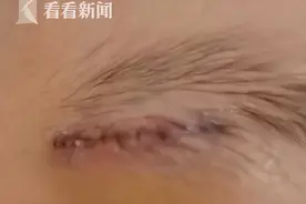 幼儿园厕所内摔倒，4岁孩子眉骨被缝22针！家长索赔28万，你怎么看？图片