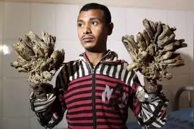 这个遗传基因缺陷，让他感染HPV病毒后变成可怕的“树人”图片