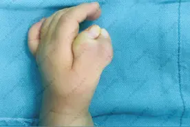 多指宝宝术后该怎么进行功能锻炼才恢复得更好？图片