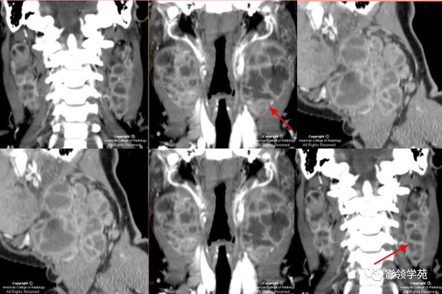 腮腺角化型鳞癌