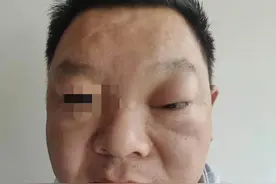 解除病痛 | 鼻窦炎反复发作？那可大意不得！图片