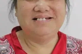 年仅56岁大姐的看牙经历：全口牙所剩无几，活动假牙越戴越差图片