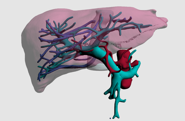 丙酸血症，一种常染色体隐形遗传，造成生化遗传症状，要及时预防