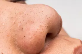 如何去黑头快速又有效？4个好用的去黑头的方法，便宜又有效图片