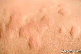 荨麻疹(起风团)，不一定是过敏导致的图片