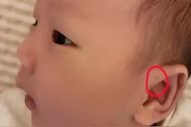新生儿耳朵有小孔是富贵命？听听医生怎么说，父母别再犯错了图片