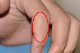 手上突然长“小水泡”，还很痒？提醒：身体发出“求救”信号图片