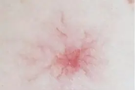 身上出现很多小红点，像小红痣，不痛不痒是怎么回事？图片