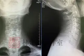 医林正骨丨颈椎病检查有哪些？看这篇就够了图片