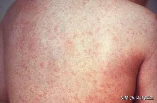 宝宝脖子上有像鸡皮疙瘩是什么
