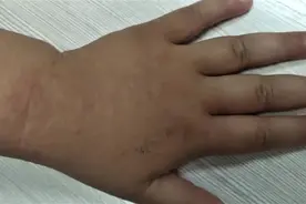 夏日常见儿童皮肤病—沙土皮炎图片