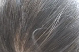 啤酒洗头去“串虫”图片