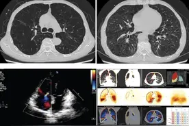 肺移植围术期的综合康复管理策略图片